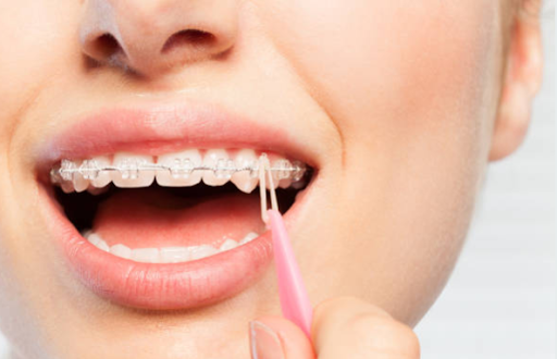 Can Ceramic Braces Damage Your Teeth