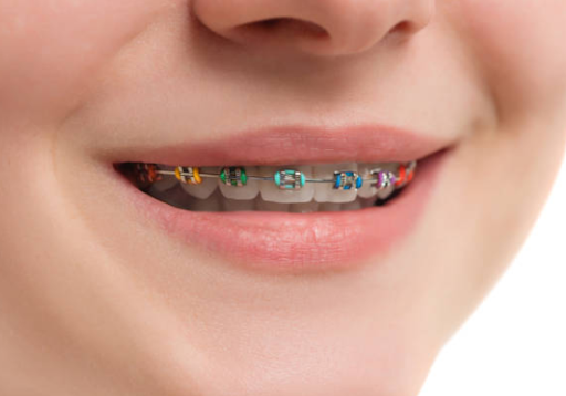 Top Benefits of Using Metal Braces