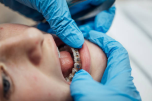 Braces cost in Leander