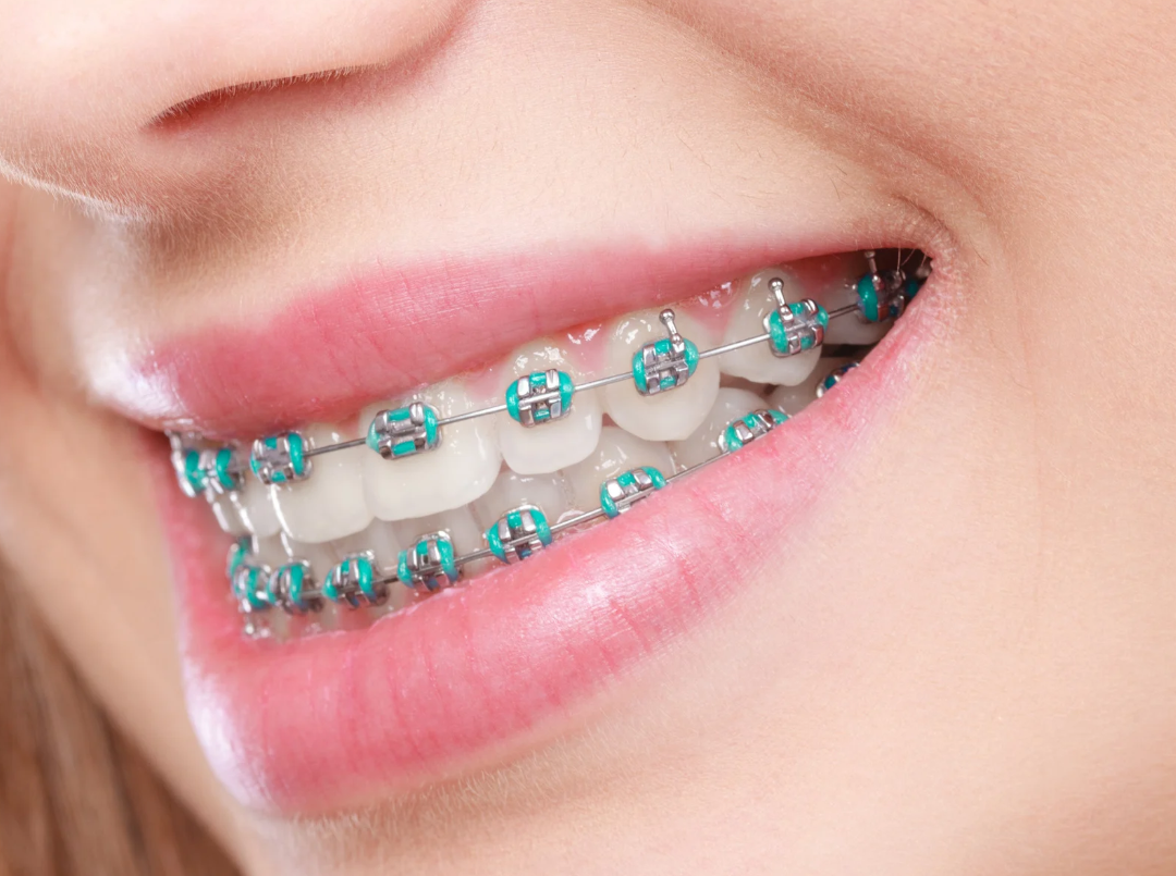 Invisalign: A Comfortable and Convenient Option