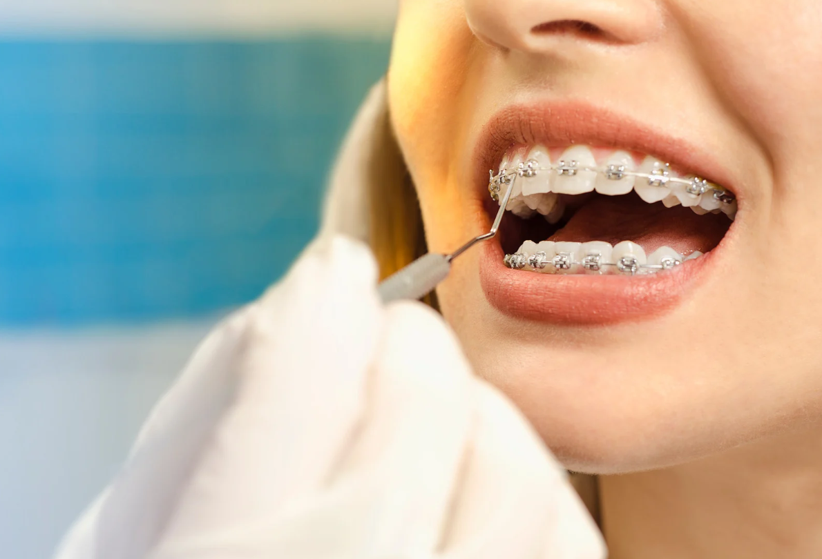 The Average Cost of Braces in Buda, TX