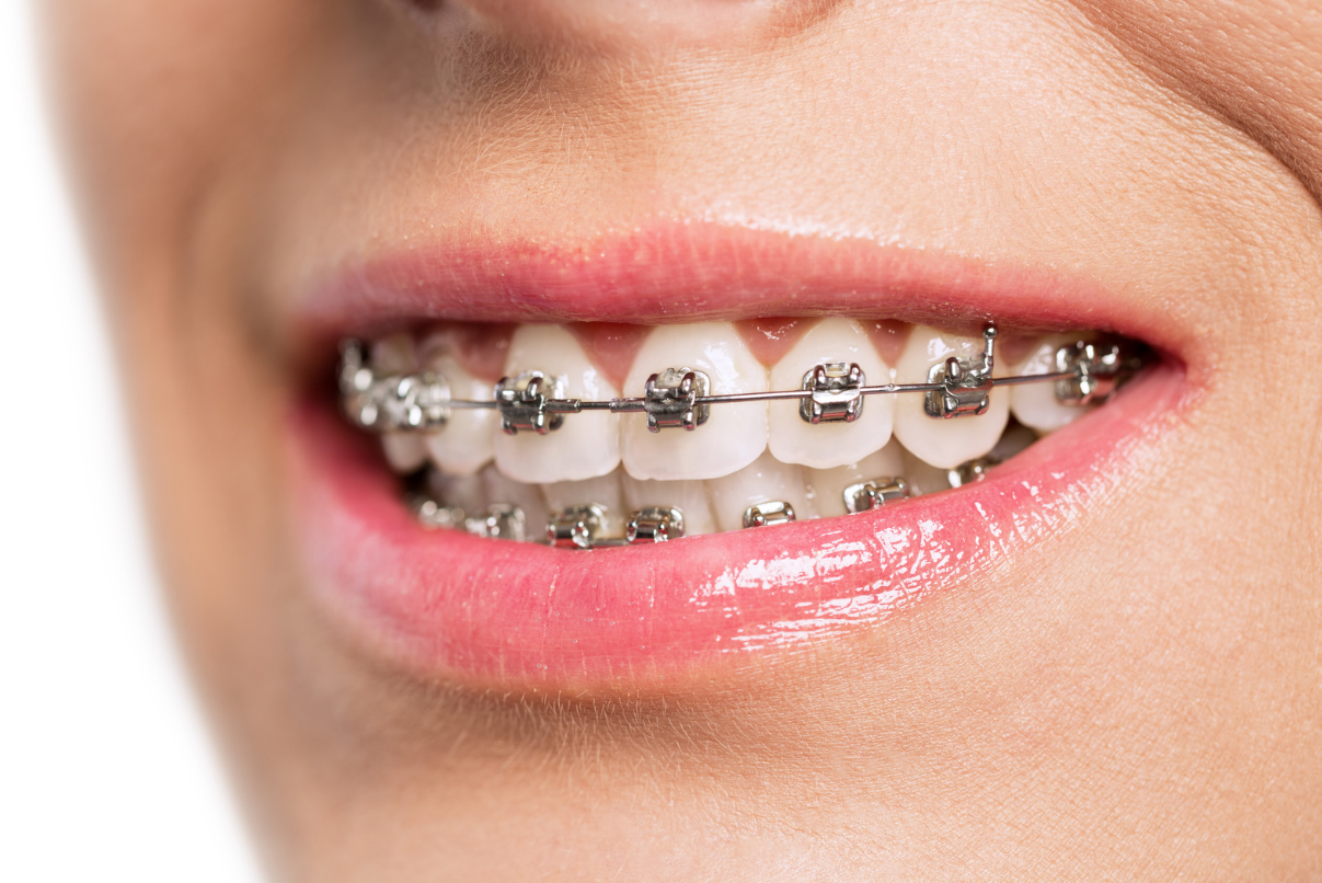 Understanding the Cost of Braces in Leander, TX