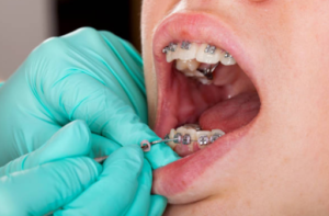 cost of braces